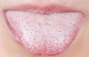 Do You Have Oral Thrush Or Just White Tongue