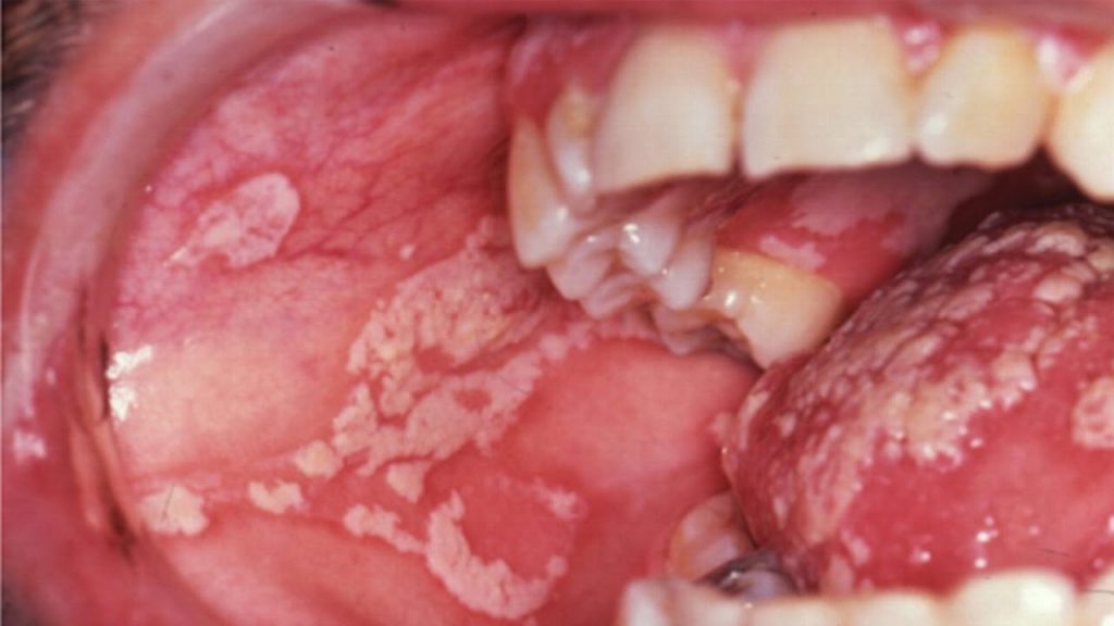 Candidiasis In The Mouth 32