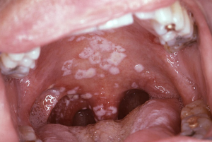 oral-thrush-causes