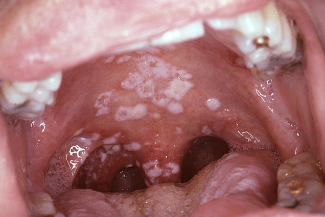 oral thrush symptoms in adults