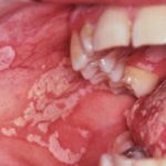 oral thrush developing
