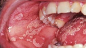 oral thrush developing