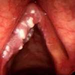 oral thrush down larynx