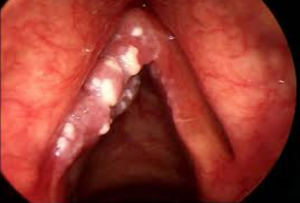 oral thrush down larynx