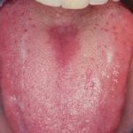 oral thrush early stages