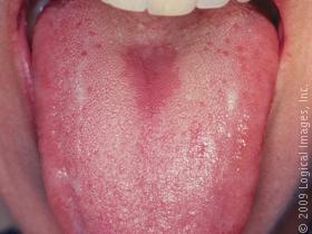 oral thrush early stages