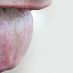 oral-thrush-images