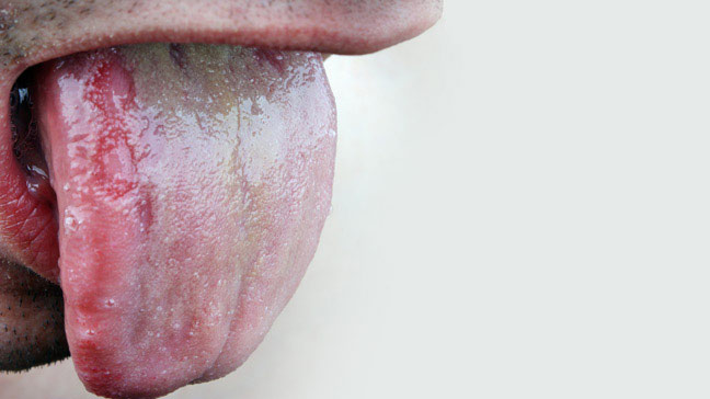 what causes thrush in the mouth