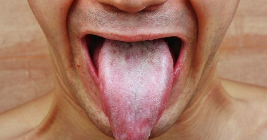 causes of mouth thrush in adults