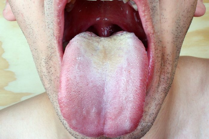 oral thrush tongue