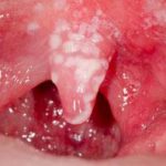 oral thrush throat