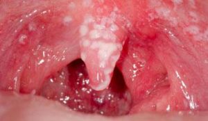 oral thrush throat