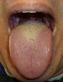 thrush-tongue